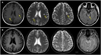 Case report: IgG4-related intracranial lesions mimicking multiple sclerosis in a 14-year-old girl